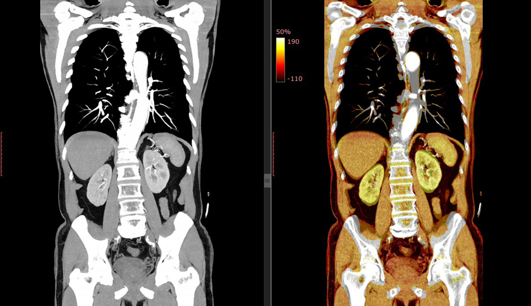 CT SCAN of Thorax and Abdomen (Computed Tomography- CAT)